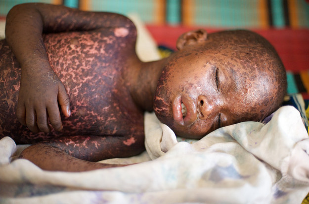 This Is What Measles Actually Looks Like - BuzzFeed News
