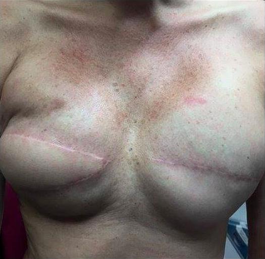 "My apologies to those that find this confrontational, but my client and I both thought it should be posted. This is a tattoo over reconstructive surgery, post a double mastectomy."