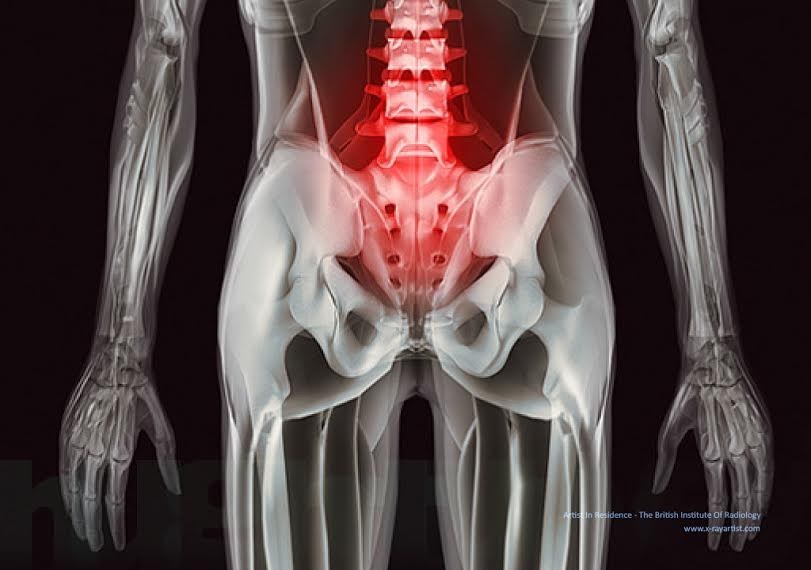 What does back pain look like? Turvey's added in colorization shows us how back pain radiates throughout your body.