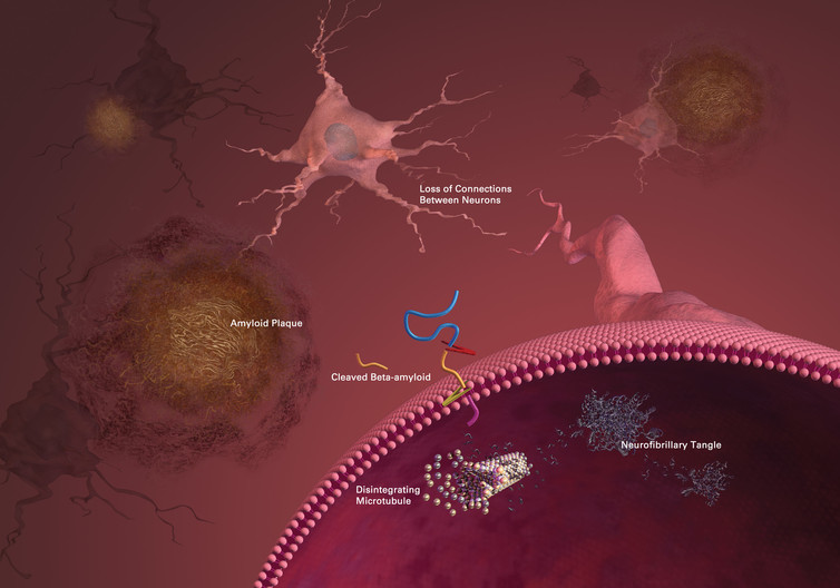 Image: Tangles and plaques characteristic of Alzheimer’s disease are the target of most treatments in development.