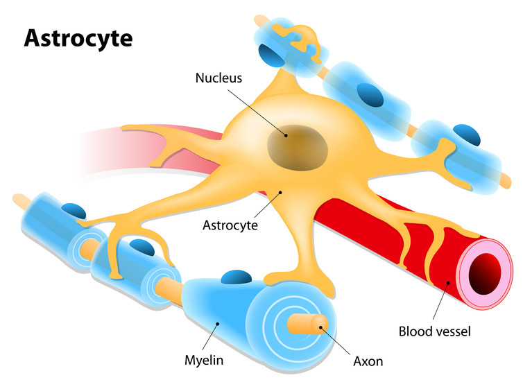 Image: These tumours grow from astrocytes - the cells that make up the supportive tissue in the brain.