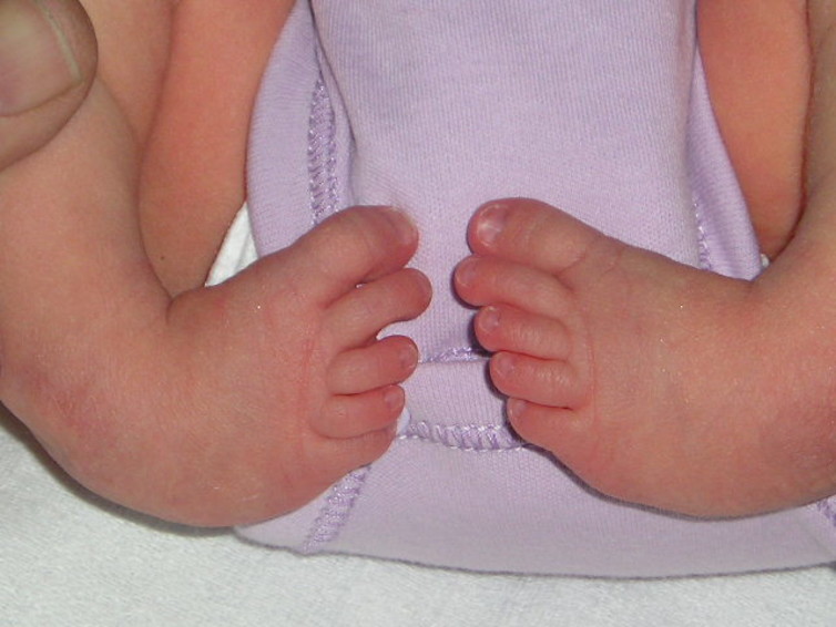 Image: Arthrogryposis of the feet (clubfoot).
