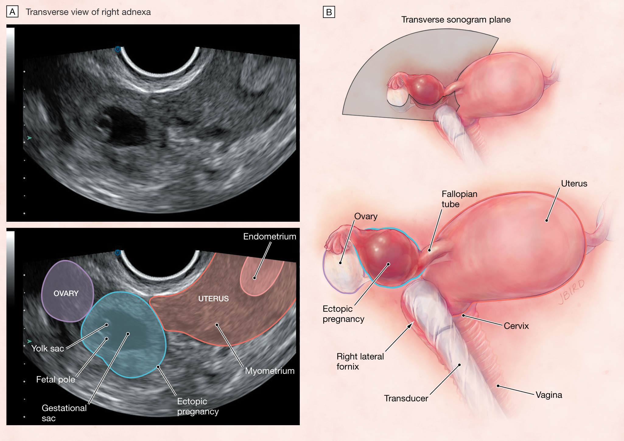 What Are the Symptoms of an Ectopic Pregnancy? - PharmacyPedia